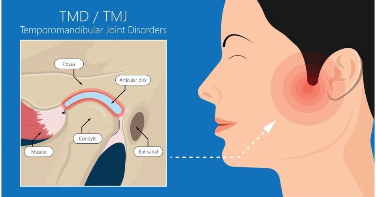viêm khớp thái dương hàm có gây lệch mặt không