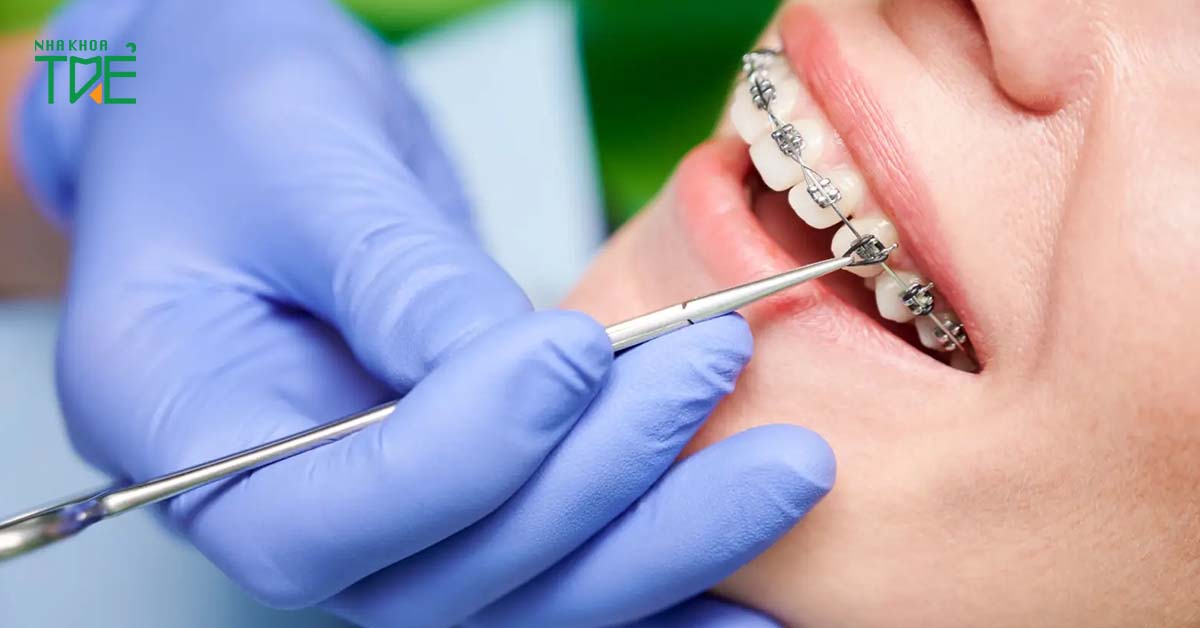 Niềng răng vẫn có thể bị viêm khớp thái dương hàm