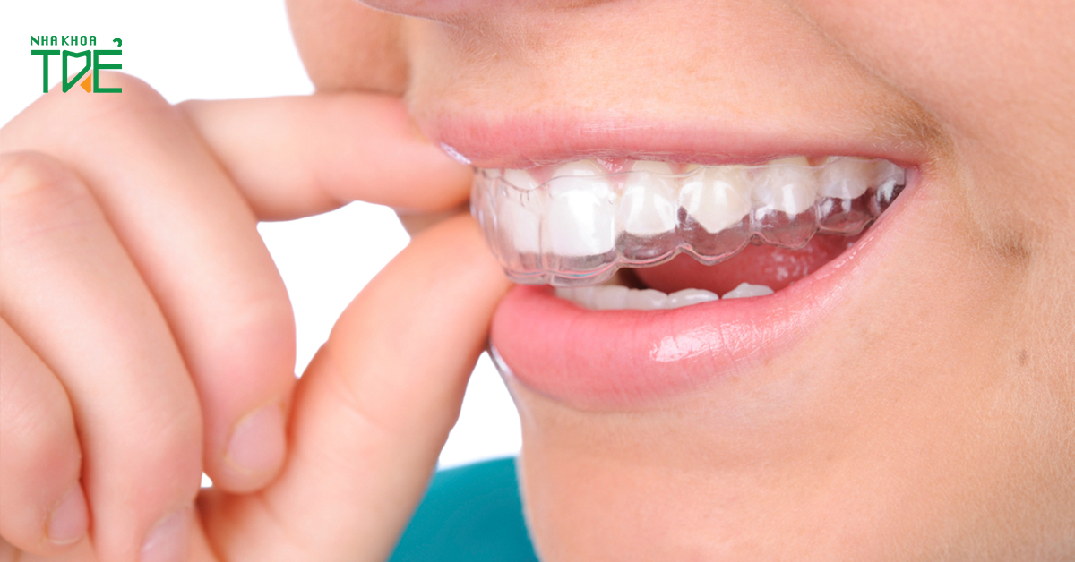 Máng nhai được thiết kế cá nhân hóa phù hợp với tình trạng bệnh