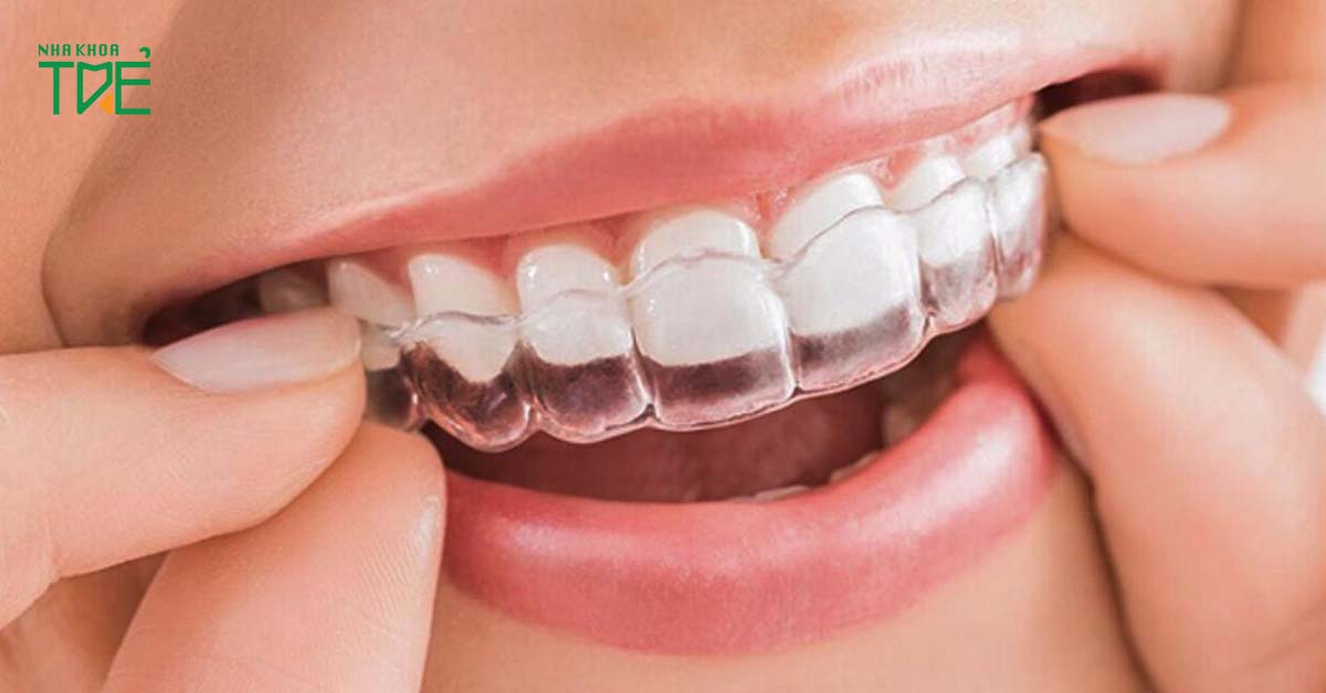 Sử dụng máng nhai để điều chỉnh khớp cắn