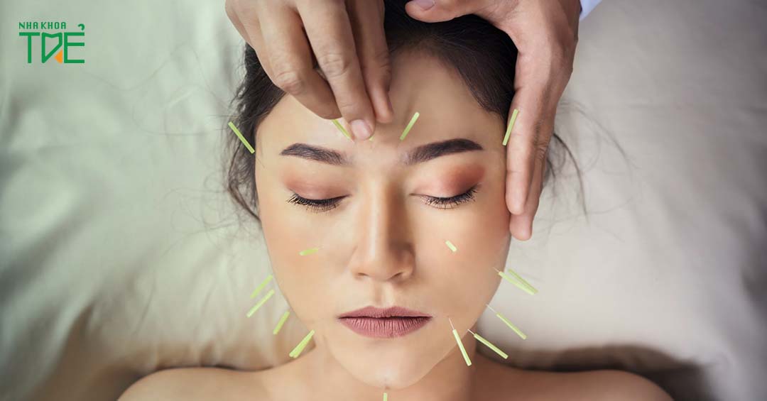 Viêm khớp thái dương hàm có châm cứu được không?