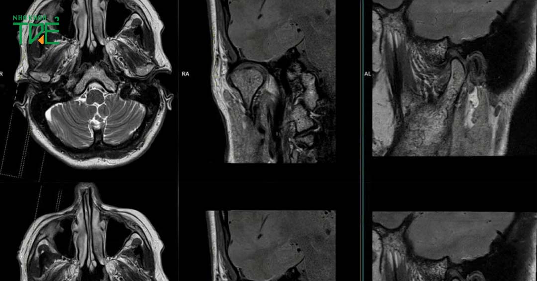 Chụp MRI khớp thái dương hàm: Đối tượng và quy trình chi tiết