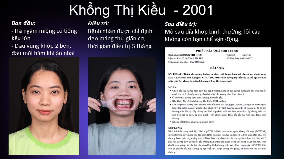 Chữa lệch khớp thái dương hàm tại Nha khoa Trẻ 