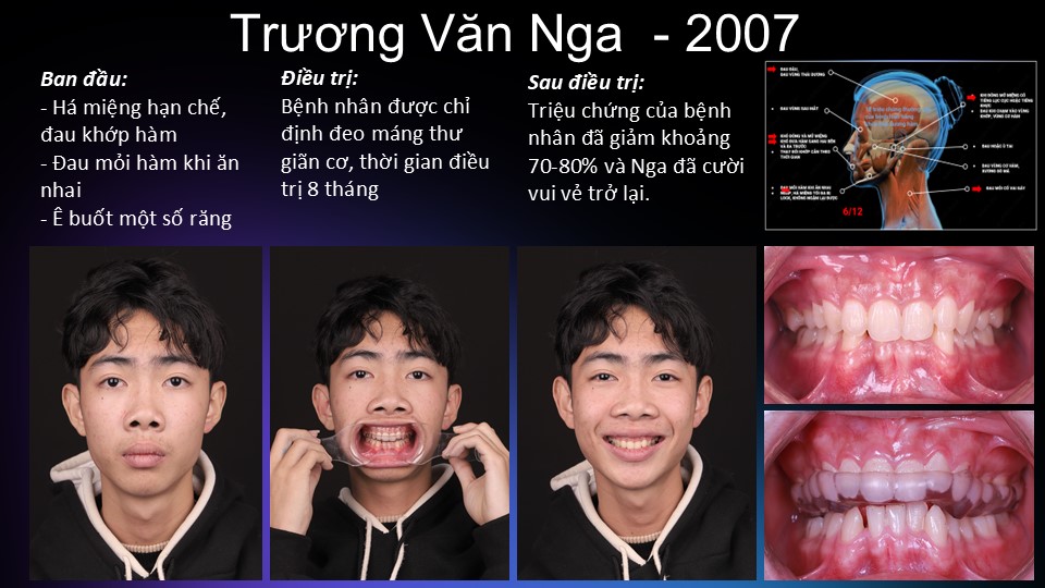 Bệnh nhân điều trị bảo tồn bằng máng nhai giúp thư giãn cơ