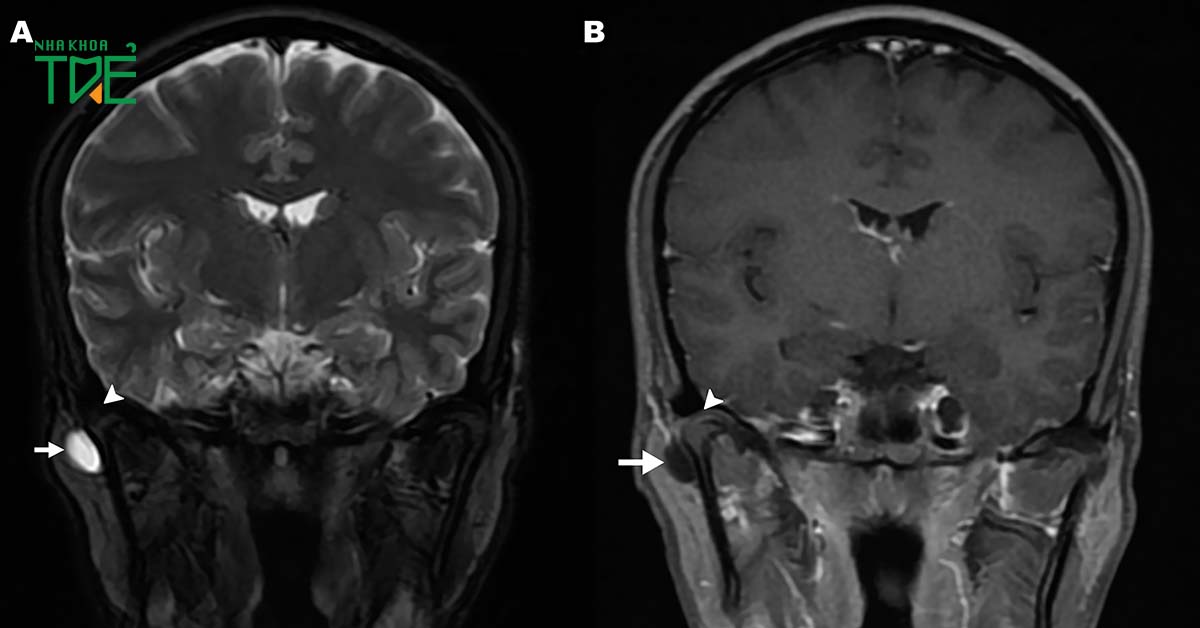 Chụp MRI khớp thái dương hàm giúp bác sĩ đánh giá tình trạng bệnh chính xác