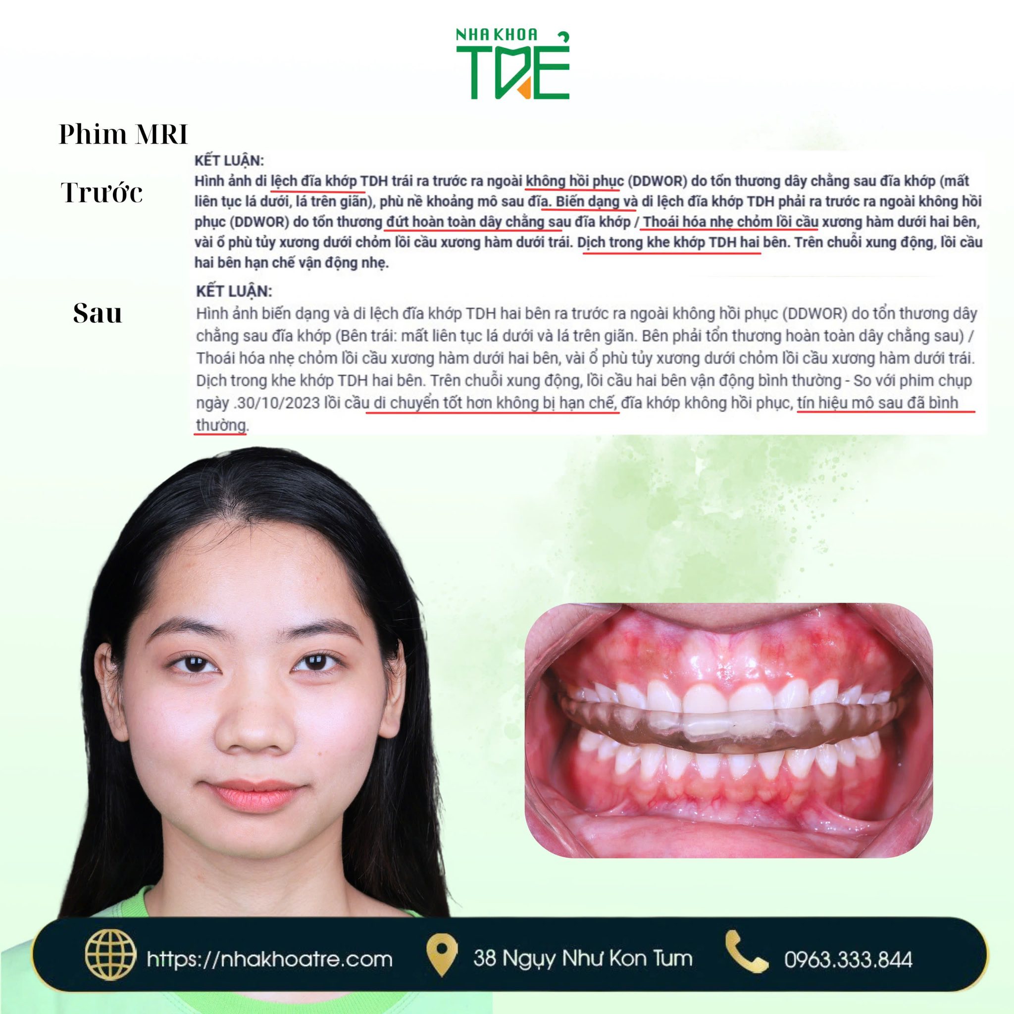 Nha Khoa Trẻ là đơn vị điều trị thoái hóa khớp thái dương hàm chuyên sâu