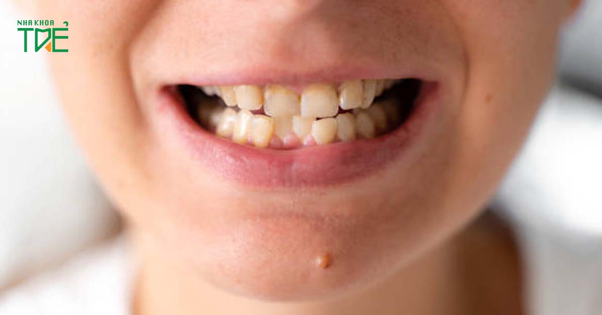 Rối loạn khớp thái dương hàm có thể khiến người bệnh bị lệch mặt