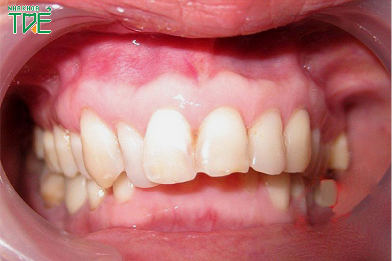 Trật khớp thái dương hàm là gì? 3 cách điều trị phổ biến