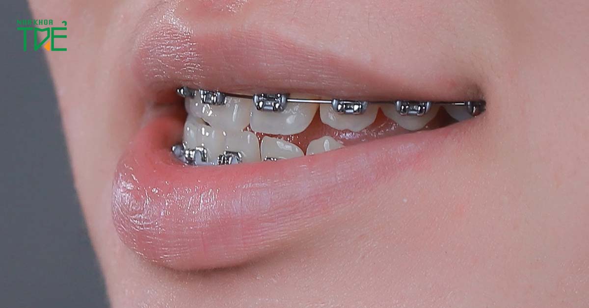 Điều chỉnh khớp cắn giúp hạn chế ảnh hưởng tiêu cực đến hệ thần kinh