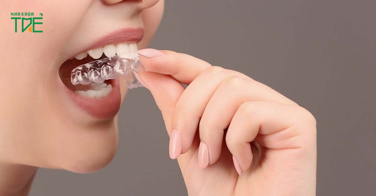 Sử dụng máng nhai giúp giảm áp lực lên khớp thái dương hàm