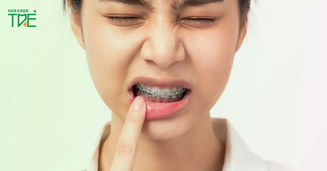 Viêm khớp thái dương hàm khi niềng răng: Dấu hiệu và cách điều trị