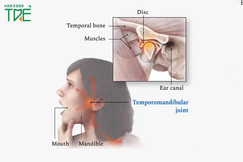 Viêm khớp thái dương hàm có tự khỏi không? Bao lâu thì khỏi?