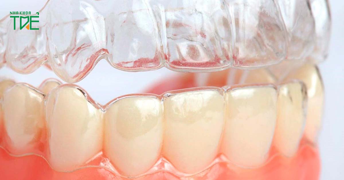 Máng nhai khớp thái dương hàm hạn chế tình trạng nghiến răng