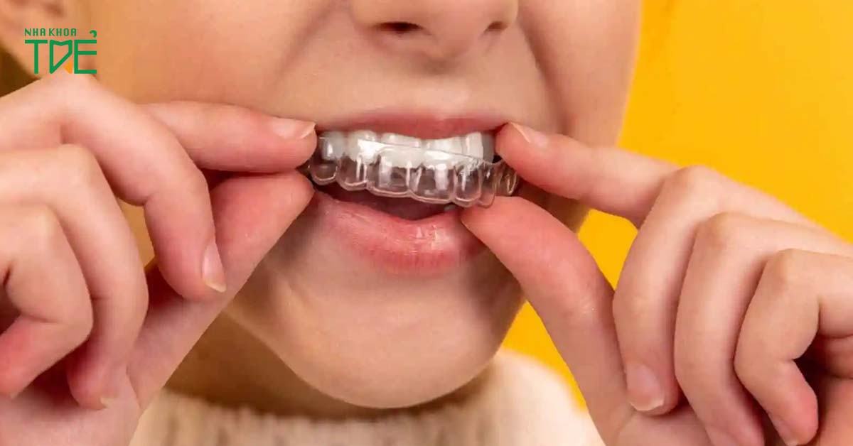 Niềng răng trong suốt vừa thẩm mỹ vừa hiệu quả trong việc điều trị viêm khớp hàm