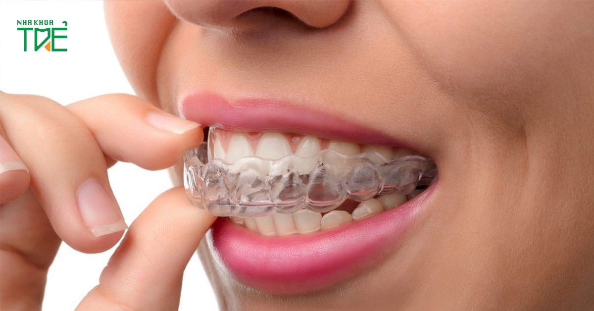 Máng nhai khớp thái dương hàm là phương pháp điều trị bảo tồn không cần phẫu thuật