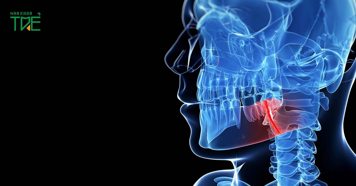 Viêm khớp thái dương hàm có thể tác động đến hệ thần kinh