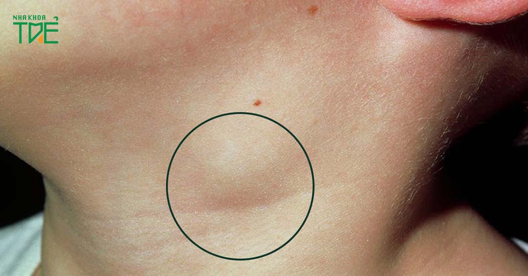 Viêm khớp thái dương hàm nổi hạch: Biến chứng và cách điều trị
