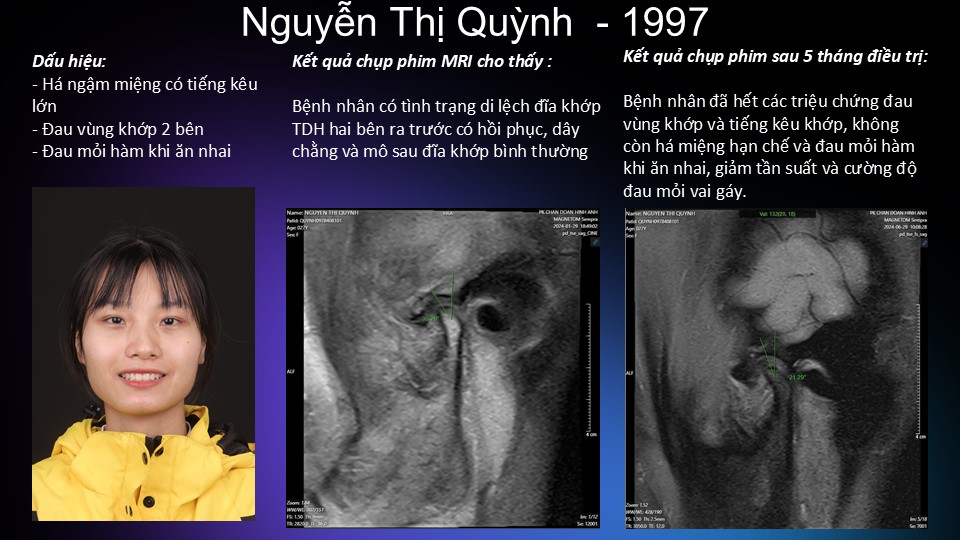 Chụp MRI khi có dấu hiệu đau mỏi khớp hàm dữ dội