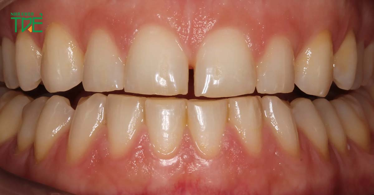 Nghiến răng khiến răng mòn và yếu dần