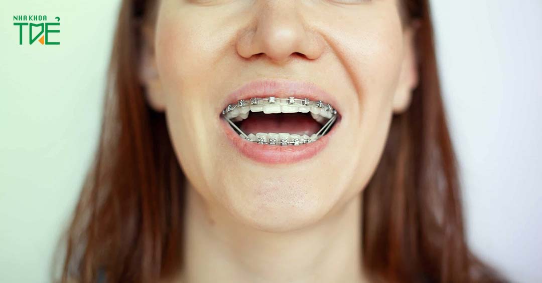 Niềng răng chữa viêm khớp thái dương hàm được không? 6 lưu ý cần biết