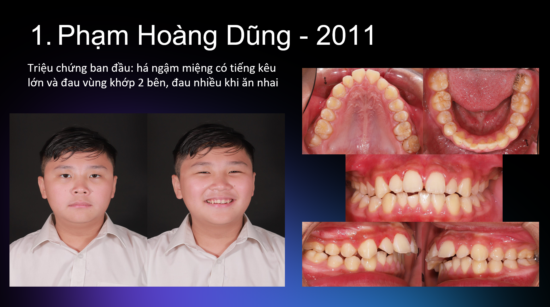 Bước 1