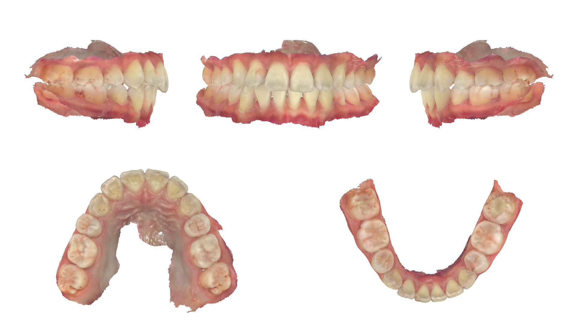 Ảnh quét mẫu răng 3D trong hồ sơ khớp thái dương hàm của bệnh nhân Alya Nar Dhifa Azhari