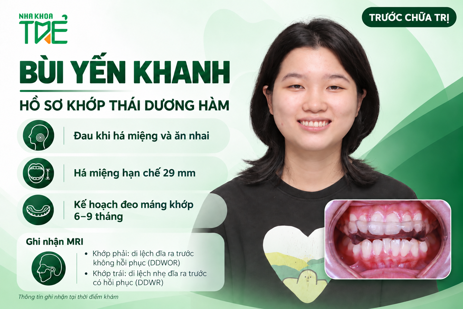 Bùi Yến Khanh trước chữa trị khớp thái dương hàm tại Nha Khoa Trẻ