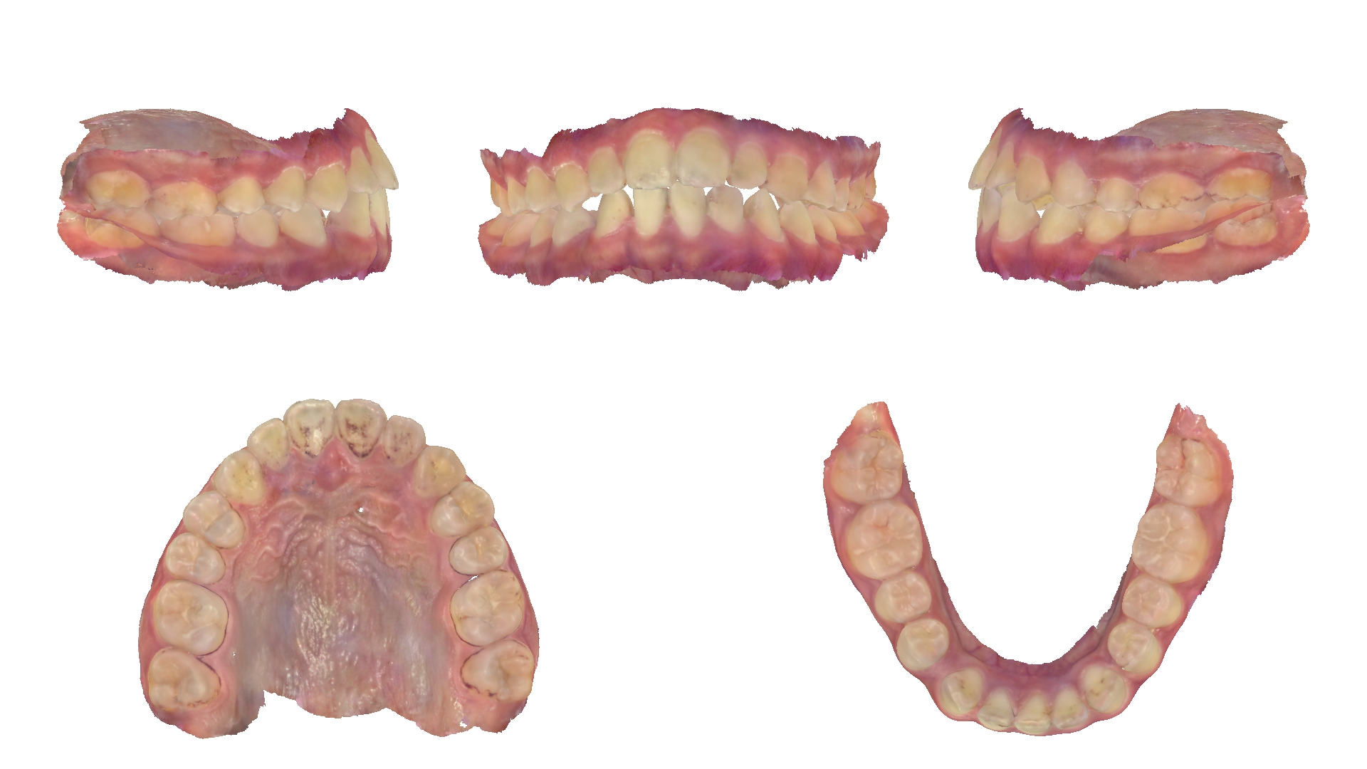 Ảnh quét mẫu răng 3D trong hồ sơ khớp thái dương hàm của bệnh nhân Lê Nguyễn Tâm Anh
