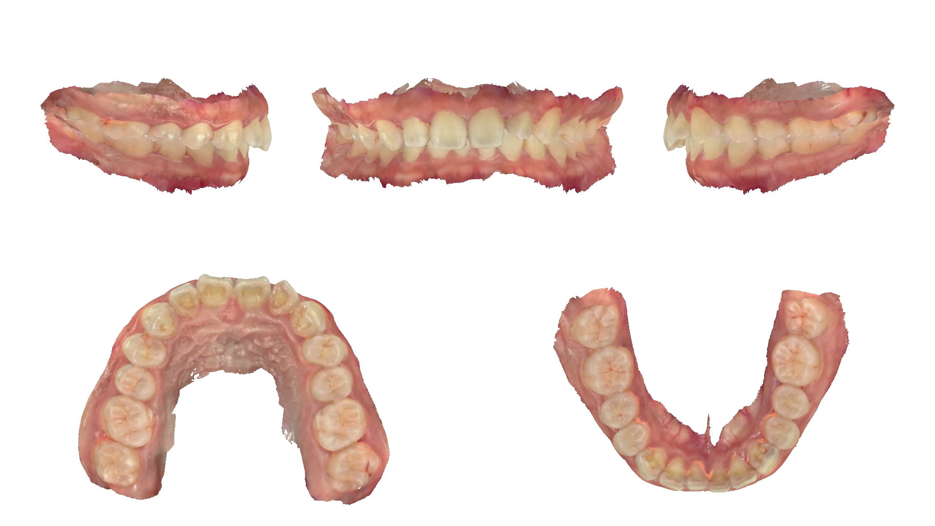 Ảnh quét mẫu răng 3D trong hồ sơ khớp thái dương hàm của bệnh nhân Nguyễn Gia Anh