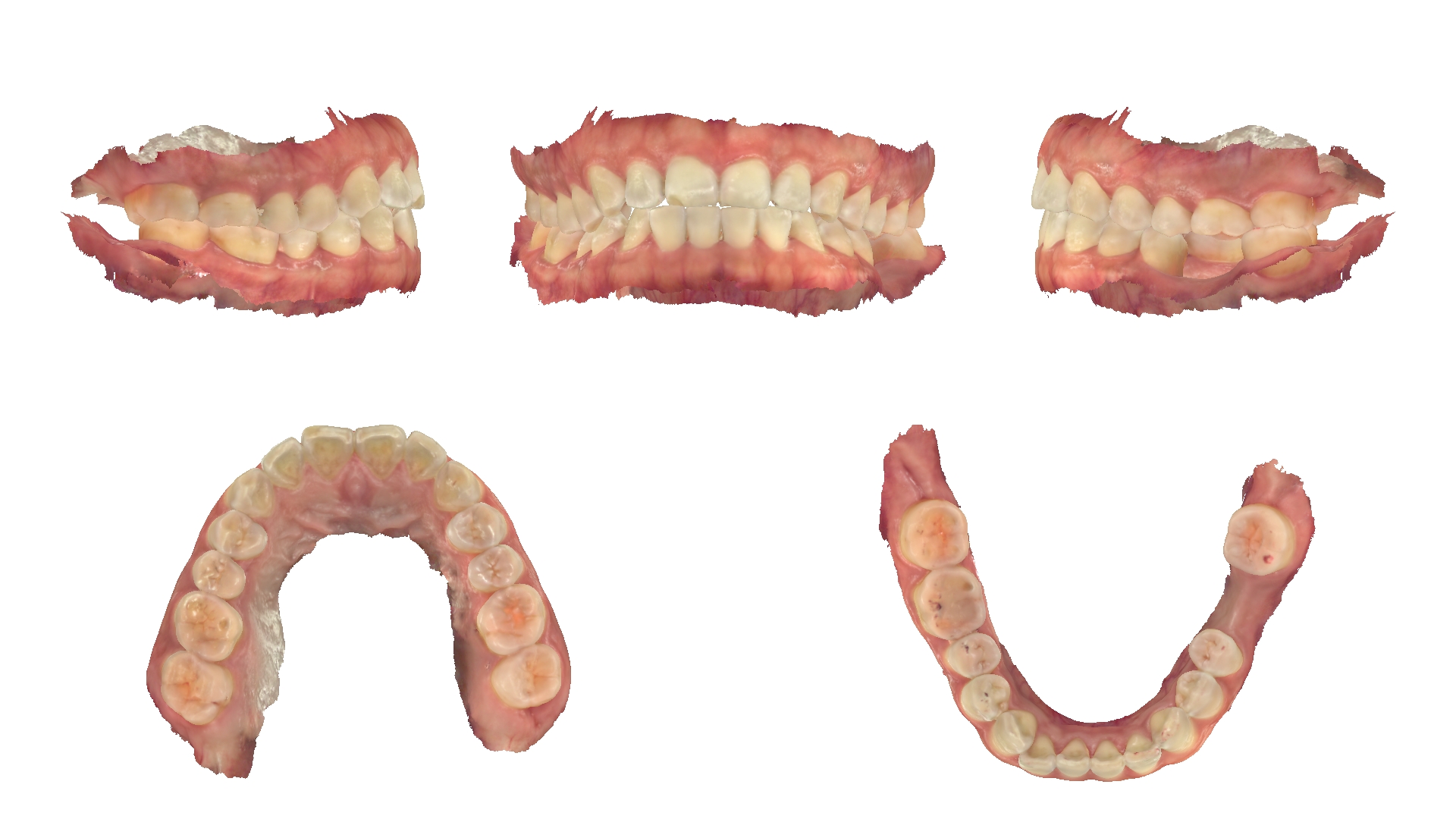 Ảnh quét mẫu răng 3D trong hồ sơ khớp thái dương hàm của bệnh nhân Nguyễn Thị Dịu Hiền