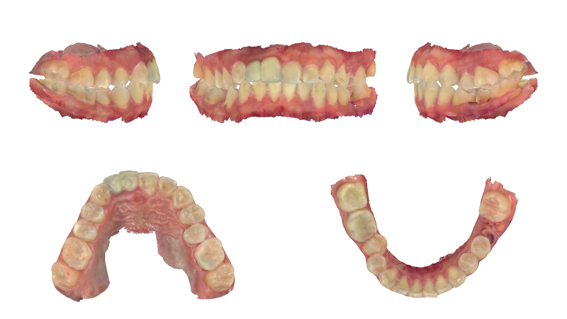 Ảnh quét mẫu răng 3D trong hồ sơ khớp thái dương hàm của bệnh nhân Nguyễn Thị Lan Hương