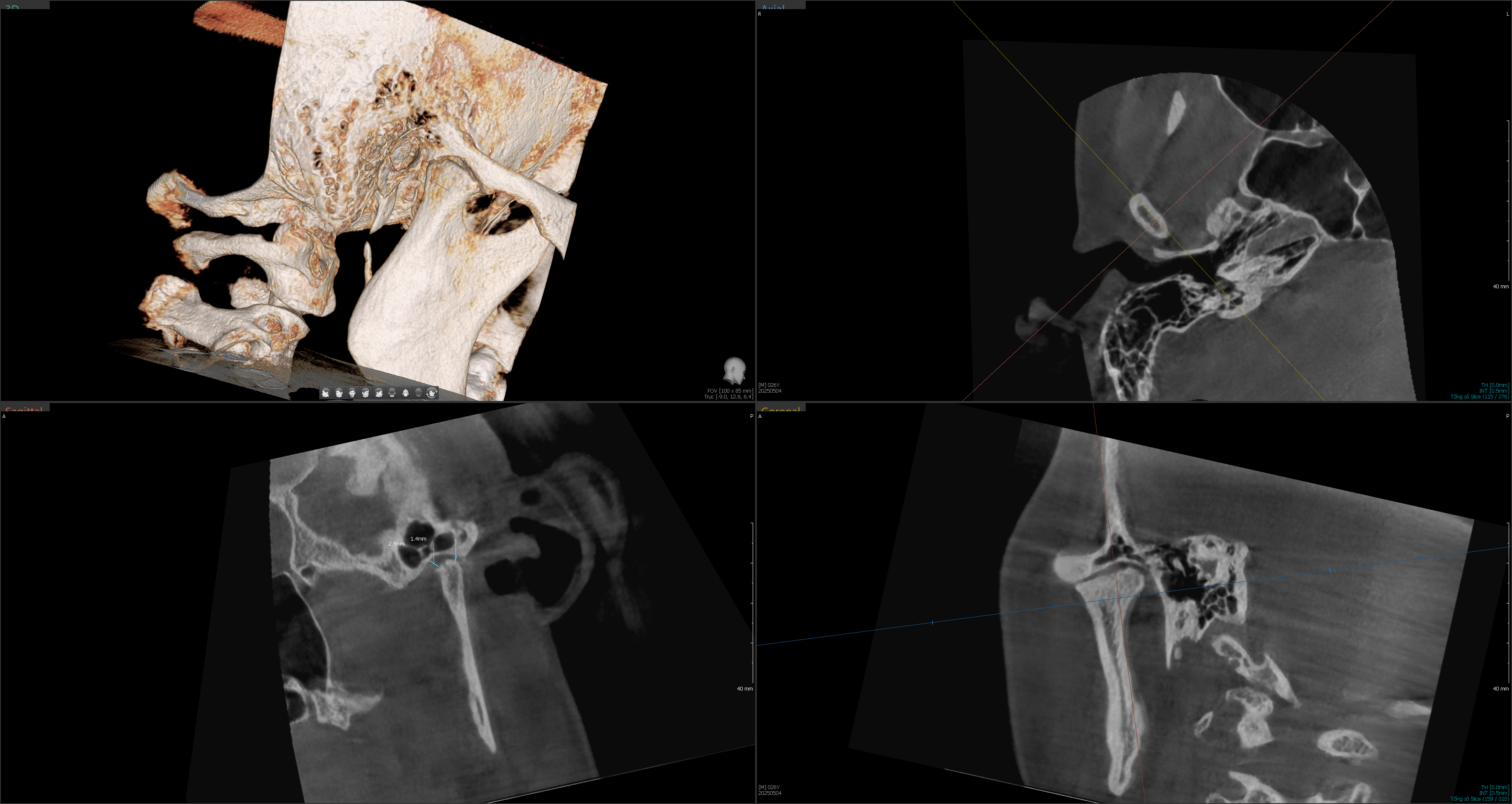 Ảnh chụp CBCT trong hồ sơ khớp thái dương hàm của bệnh nhân Nguyễn Thị Thu Trà