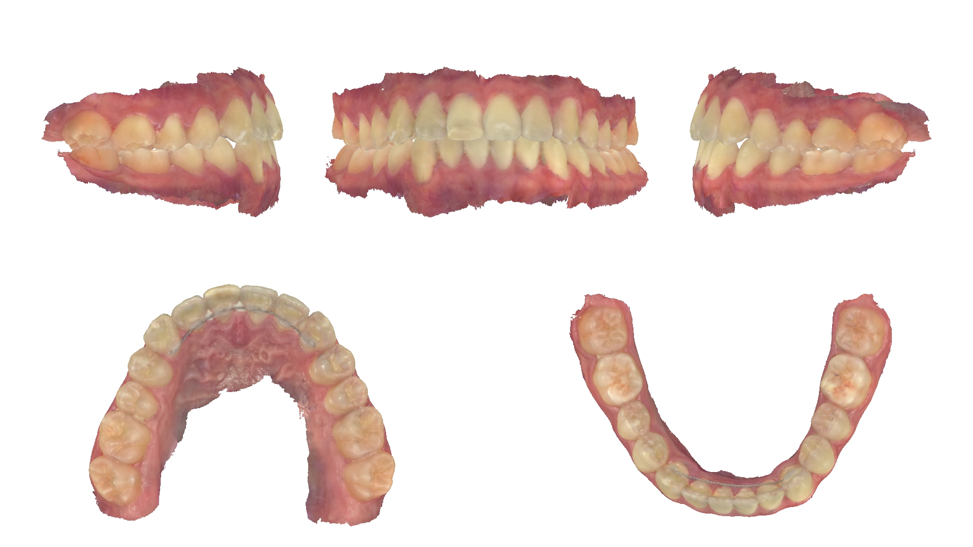 Ảnh quét mẫu răng 3D trong hồ sơ khớp thái dương hàm của bệnh nhân Nguyễn Vũ Tuấn Minh