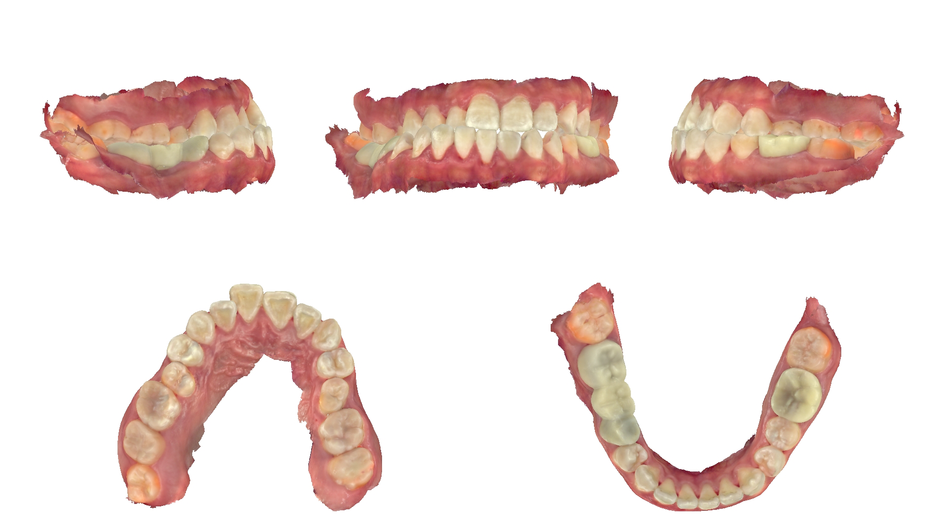 Ảnh quét mẫu răng 3D trong hồ sơ khớp thái dương hàm của bệnh nhân Trương Minh Đạt