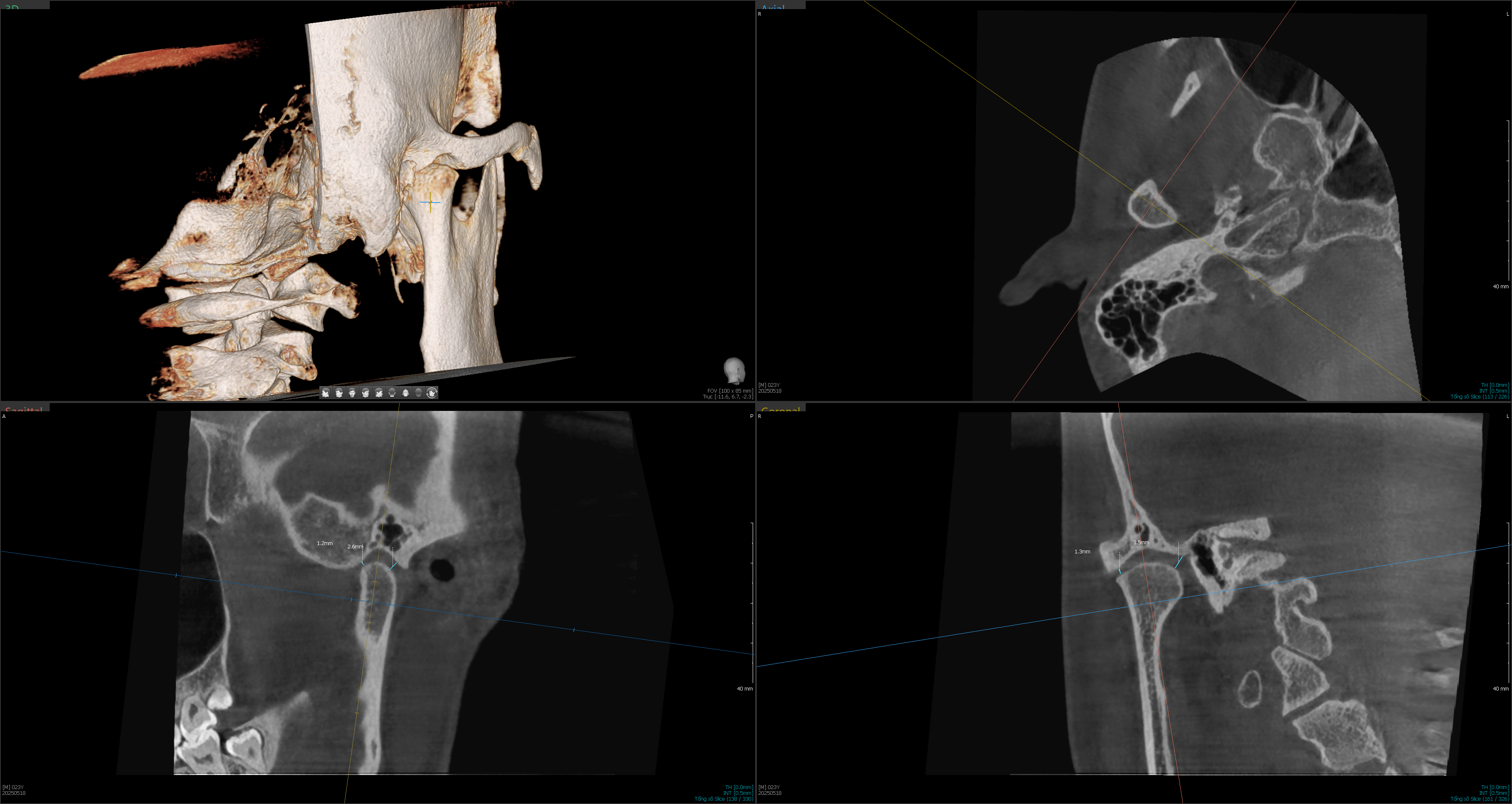 Ảnh chụp CBCT trong hồ sơ khớp thái dương hàm của bệnh nhân Đinh Thị Lan Anh