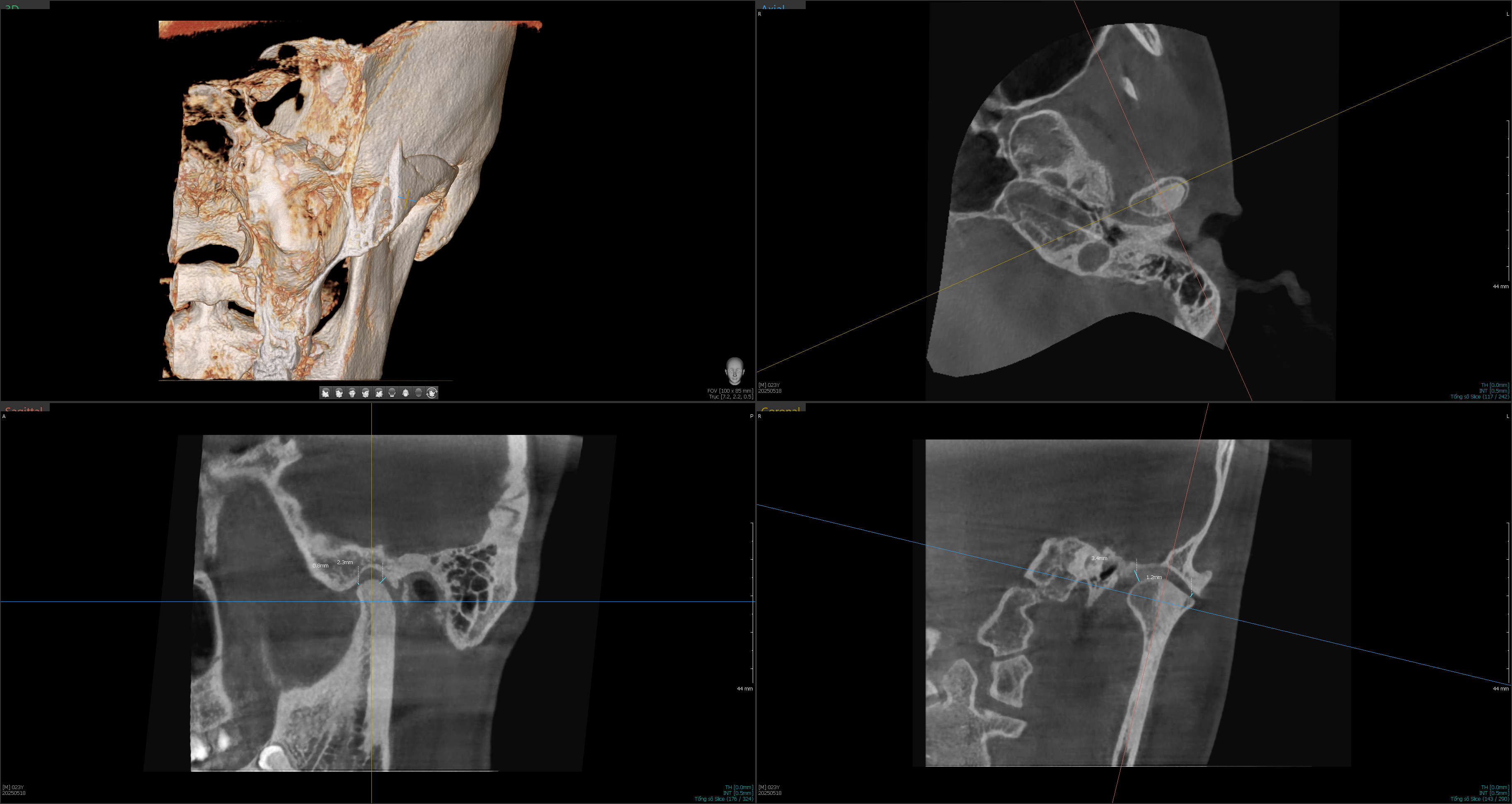 Ảnh chụp CBCT trong hồ sơ khớp thái dương hàm của bệnh nhân Đinh Thị Lan Anh